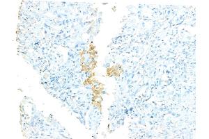 ABIN7094529 and ABIN7098578 at 1/100 staining Human lung cancer by IHC-P. (STIL Antikörper  (C-Term))