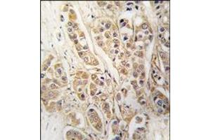 Formalin-fixed and paraffin-embedded human breast carcinoma tissue reacted with CLIC4 antibody, which was peroxidase-conjugated to the secondary antibody, followed by DAB staining. (CLIC4 Antikörper)