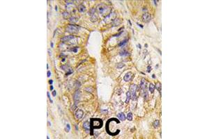 Formalin-fixed and paraffin-embedded human prostate carcinoma tissue reacted with PDGFRA polyclonal antibody  , which was peroxidase-conjugated to the secondary antibody, followed by DAB staining. (PDGFRA Antikörper  (Tyr768))
