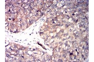 Immunohistochemistry (IHC) image for anti-Ribonucleotide Reductase M1 (RRM1) (AA 541-792) antibody (ABIN7193575)