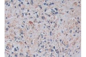 Detection of ADAM17 in Human Prostate cancer Tissue using Monoclonal Antibody to A Disintegrin And Metalloprotease 17 (ADAM17) (ADAM17 Antikörper  (AA 226-473))