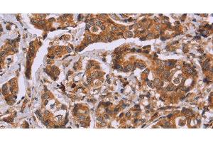Immunohistochemistry of paraffin-embedded Human breast cancer tissue using CALCA Polyclonal Antibody at dilution 1:40 (CGRP Antikörper)