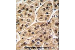 Formalin-fixed and paraffin-embedded human hepatocarcinoma tissue reacted with POLR1C antibody (C-term) (ABIN389351 and ABIN2839457) , which was peroxidase-conjugated to the secondary antibody, followed by DAB staining. (POLR1C Antikörper  (C-Term))