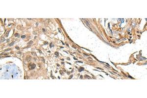 Immunohistochemistry of paraffin-embedded Human esophagus cancer tissue using MAPK4 Polyclonal Antibody at dilution of 1:35(x200) (MAPK4 Antikörper)