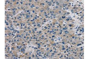 The image on the left is immunohistochemistry of paraffin-embedded Human liver cancer tissue using ABIN7131311(TBX18 Antibody) at dilution 1/20, on the right is treated with fusion protein. (T-Box 18 Antikörper)