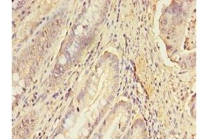 Immunohistochemistry of paraffin-embedded human colon cancer using ABIN7151689 at dilution of 1:100 (ERGIC1 Antikörper  (AA 48-254))