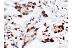 Immunohistochemical analysis of paraffin embedded cancer sections, staining in nucleus, DAB chromogenic reaction (BNIP3 Antikörper  (C-Term))