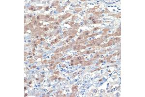 Immunohistochemistry of paraffin-embedded human liver cancer using [KO Validated] Smad4 Rabbit mAb (ABIN7270340) at dilution of 1:100 (40x lens). (SMAD4 Antikörper)