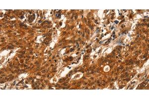 Immunohistochemistry of paraffin-embedded Human gastric cancer using CUEDC2 Polyclonal Antibody at dilution of 1:50 (CUEDC2 Antikörper)
