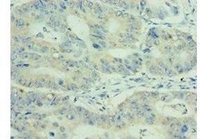 Immunohistochemistry of paraffin-embedded human colon cancer using ABIN7159411 at dilution of 1:100 (MEP1A Antikörper  (AA 440-700))