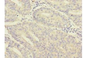 Immunohistochemistry of paraffin-embedded human endometrial cancer using ABIN7160214 at dilution of 1:100
