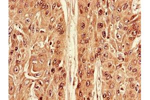 Immunohistochemistry of paraffin-embedded human cervical cancer using ABIN7174538 at dilution of 1:100