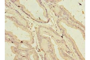 Immunohistochemistry of paraffin-embedded human prostate cancer using ABIN7144619 at dilution of 1:100 (ARMCX1 Antikörper  (AA 29-300))