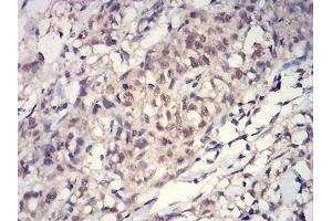 Immunohistochemical analysis of paraffin-embedded breast cancer tissues using HIST2H3C(27Ac) mouse mAb with DAB staining. (Histone Cluster 2, H3c (HIST2H3C) (acLys27) Antikörper)
