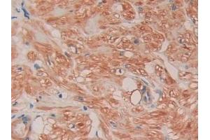 Detection of FLNC in Human Prostate Tissue using Polyclonal Antibody to Filamin C Gamma (FLNC) (FLNC Antikörper  (AA 17-259))