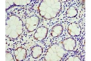 Immunohistochemistry of paraffin-embedded human colon cancer using ABIN7146792 at dilution of 1:100