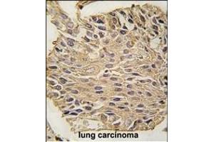 Formalin-fixed and paraffin-embedded human lung carcinoma tissue reacted with ALDOA antibody (C-term) (ABIN389192 and ABIN2839355) , which was peroxidase-conjugated to the secondary antibody, followed by DAB staining. (ALDOA Antikörper  (C-Term))