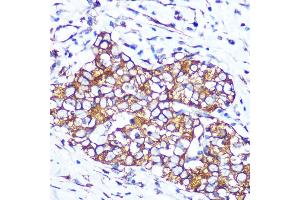 Immunohistochemistry of paraffin-embedded human esophageal cancer using Pannexin 1 Rabbit mAb (ABIN7269168) at dilution of 1:100 (40x lens). (PANX1 Antikörper)