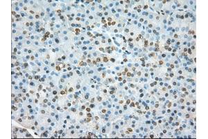 Immunohistochemical staining of paraffin-embedded Adenocarcinoma of colon tissue using anti-TACC3 mouse monoclonal antibody. (TACC3 Antikörper)