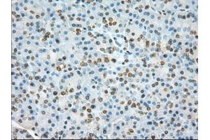 Immunohistochemical staining of paraffin-embedded Adenocarcinoma of colon tissue using anti-TACC3 mouse monoclonal antibody.