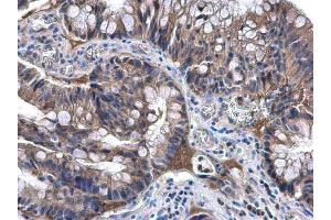 IHC-P Image NAT1 antibody [N1C1] detects NAT1 protein at cytoplasm in human colon carcinoma by immunohistochemical analysis. (NAT1 Antikörper)