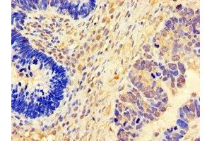 Immunohistochemistry of paraffin-embedded human ovarian cancer using ABIN7152824 at dilution of 1:100 (FGF8 Antikörper  (AA 23-143))