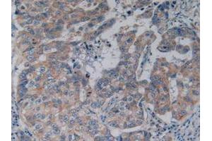 IHC-P analysis of Human Breast Cancer Tissue, with DAB staining. (NFkB Antikörper  (AA 805-892))