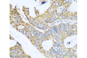 Immunohistochemistry of paraffin-embedded Human colon carcinoma using GLUD1 Polyclonal Antibody at dilution of 1:100 (40x lens). (GLUD1 Antikörper)