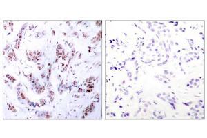 Immunohistochemical analysis of paraffin-embedded human breast carcinoma tissue using MEF2A (Ab-312) antibody (E021039). (MEF2A Antikörper)