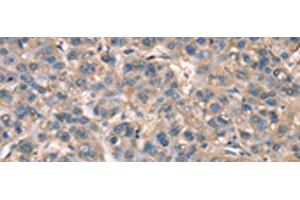 Immunohistochemistry of paraffin-embedded Human liver cancer tissue using ZFYVE19 Polyclonal Antibody at dilution of 1:60(x200) (ZFYVE19 Antikörper)