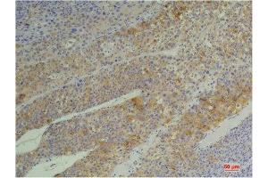 Immunohistochemistry (IHC) analysis of paraffin-embedded Human Heptacarcinoma using Cyclophilin B Mouse Monoclonal Antibody diluted at 1:200. (PPIB Antikörper)