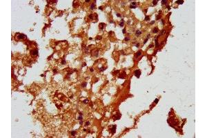 IHC image of ABIN7164700 diluted at 1:100 and staining in paraffin-embedded human melanoma performed on a Leica BondTM system. (HBEGF Antikörper  (AA 63-148))