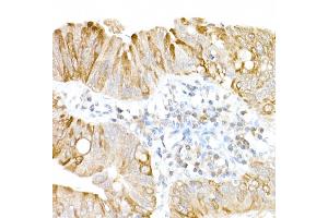 Immunohistochemistry of paraffin-embedded human colon carcinoma using USP18 Rabbit pAb (ABIN7271145) at dilution of 1:25 (40x lens). (USP18 Antikörper  (AA 200-300))