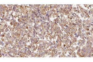 ABIN6278895 at 1/100 staining Human Melanoma tissue by IHC-P. (IL17F Antikörper  (Internal Region))