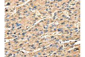 The image on the left is immunohistochemistry of paraffin-embedded Human liver cancer tissue using ABIN7131239(STX18 Antibody) at dilution 1/25, on the right is treated with fusion protein. (Syntaxin 18 Antikörper)