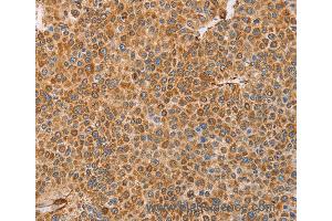 Immunohistochemistry of Human cervical cancer using BRS3 Polyclonal Antibody at dilution of 1:30 (BRS3 Antikörper)