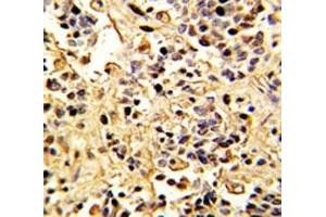 IHC analysis of FFPE human kidney carcinoma with Neprilysin antibody