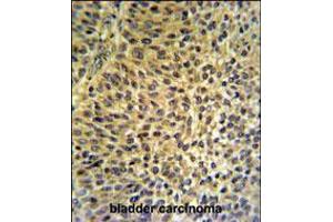 FUT6 Antibody IHC analysis in formalin fixed and paraffin embedded bladder carcinoma followed by peroxidase conjugation of the secondary antibody and DAB staining.
