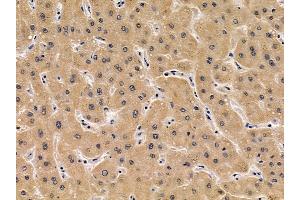 ABIN6256932 and ABIN6275042 at 1/100 staining human liver cancer by IHC-P. (Coxsackie Adenovirus Receptor Antikörper  (N-Term))