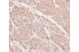 DAB staining on IHC-P; Samples: Human Prostate Gland Cancer Tissue. (HFE2 Antikörper  (AA 234-416))