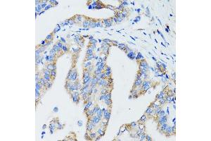 Immunohistochemistry of paraffin-embedded human gastric cancer using USO1 antibody. (USO1 Antikörper)