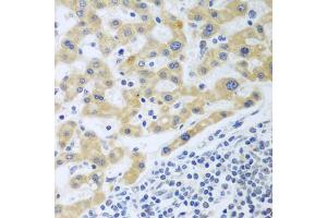 Immunohistochemistry of paraffin-embedded human liver cancer using SHBG antibody (ABIN6129327, ABIN6147736, ABIN6147737 and ABIN6223329) at dilution of 1:100 (40x lens). (SHBG Antikörper  (AA 30-170))