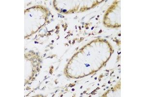Immunohistochemistry of paraffin-embedded human gastric using UBE3A antibody (ABIN5975332) at dilution of 1/200 (40x lens). (ube3a Antikörper)