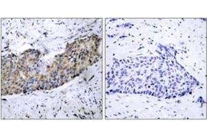 Immunohistochemistry analysis of paraffin-embedded human breast carcinoma tissue, using VEGFR2 (Ab-1214) Antibody. (VEGFR2/CD309 Antikörper  (AA 1180-1229))
