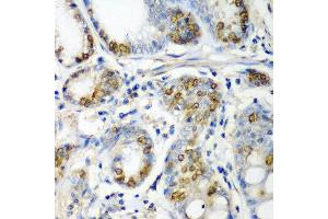 Immunohistochemistry of paraffin-embedded human colon carcinoma using CRYAA antibody at dilution of 1:200 (40x lens). (CRYAA Antikörper)