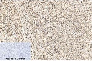 Immunohistochemical analysis of paraffin-embedded human uterus cancer tissue.