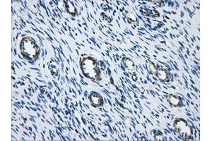 Immunohistochemical staining of paraffin-embedded Adenocarcinoma of breast tissue using anti-ACO2 mouse monoclonal antibody. (ACO2 Antikörper)
