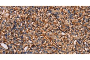 Immunohistochemistry of paraffin-embedded Human prostate cancer tissue using PLXNA1 Polyclonal Antibody at dilution 1:30 (Plexin A1 Antikörper)