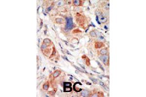 Formalin-fixed and paraffin-embedded human cancer tissue reacted with PIK3CD polyclonal antibody  , which was peroxidase-conjugated to the secondary antibody, followed by DAB staining. (PIK3CD Antikörper  (C-Term))