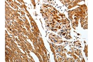 The image on the left is immunohistochemistry of paraffin-embedded Human cervical cancer tissue using ABIN7192428(SLC22A3 Antibody) at dilution 1/25, on the right is treated with synthetic peptide. (SLC22A3 Antikörper)